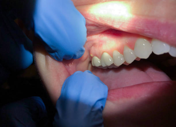Best Emergency Dental Care for Abscessed Tooth in Pimlico, SC